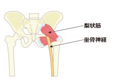 梨状筋症候群 健やか整骨院